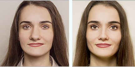 Rinoplastie, imagini înainte - după